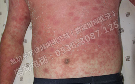 去濰坊哪家醫院檢查能確診是不是牛皮癬