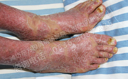 濰坊較便宜的牛皮癬治療醫院