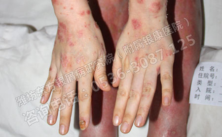 確診是牛皮癬怎么好的持續可以轉且效果穩定