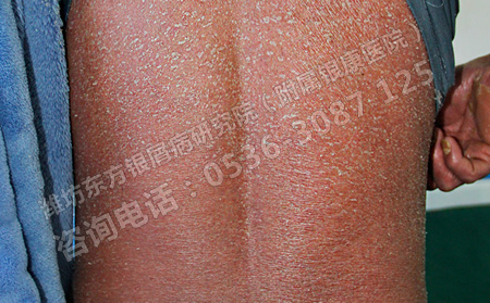 夏季到來牛皮癬病情加重是為什么呢