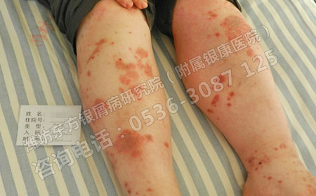 小面積輕微牛皮癬要怎么穩(wěn)定住病情發(fā)展