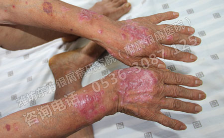 夏天雨季關節型牛皮癬患者的護理措施