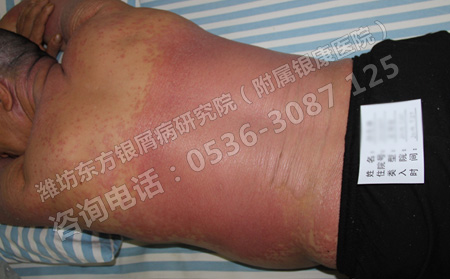 造成牛皮癬的主要原因到底有哪些呢