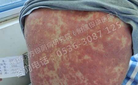 牛皮癬易復發(fā)難好的有什么方法改善這一現(xiàn)狀