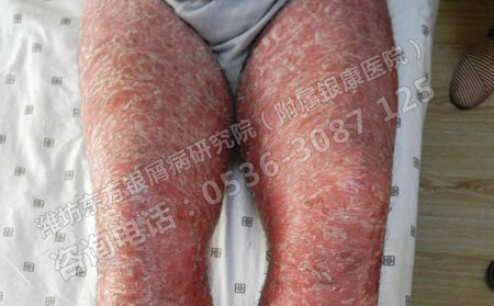 如何護理重癥牛皮癬