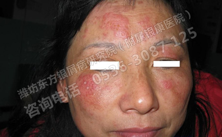 濰坊牛皮癬醫院是如何治療牛皮癬的