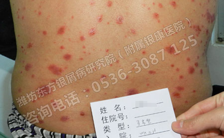 輕微牛皮癬的治療能好的嗎