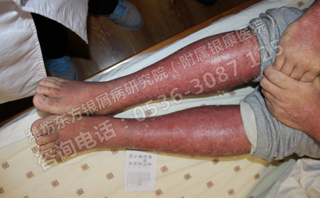 怎樣做好銀屑病的護理工作呢