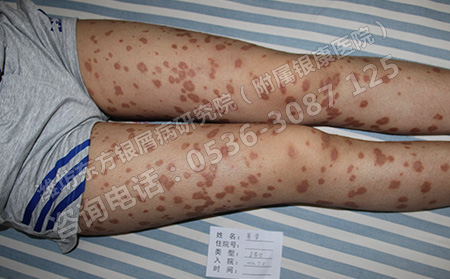 夏季如何科學護理女性牛皮癬