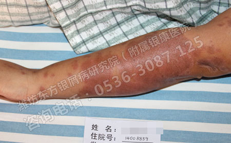 雨水季節(jié)牛皮癬高發(fā)原因