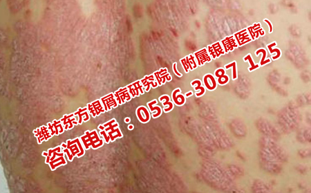 當心一些生活習慣誘發銀屑病的出現