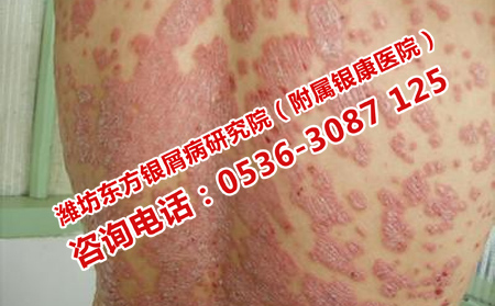 夏季從哪幾個方面做好銀屑病的護理