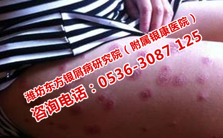 夏季銀屑病預防技巧你知道嗎