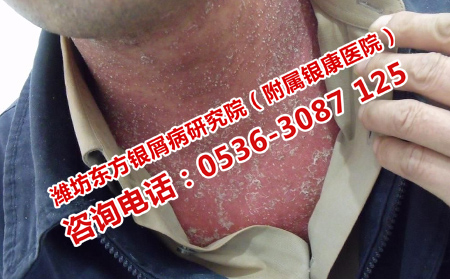 頭部銀屑病出現瘙癢怎么辦
