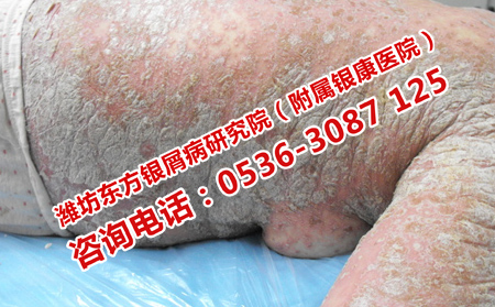 天氣逐漸變熱銀屑病患者日常護理四大問題