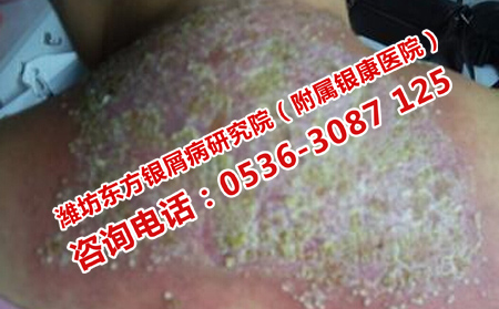 不利于防治銀屑病的生活方式是什么