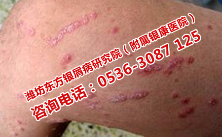 五月如何做好銀屑病的護理