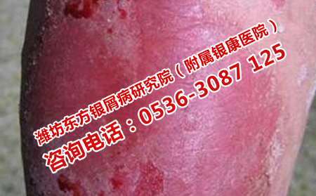 銀屑病患者如何科學護理銀屑病
