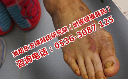 女性牛皮癬病情怎么控制比較好