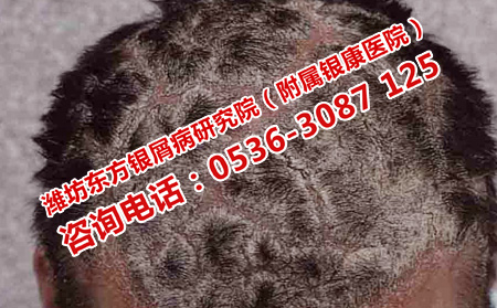 頭部銀屑病科學護理的有效方法有哪些