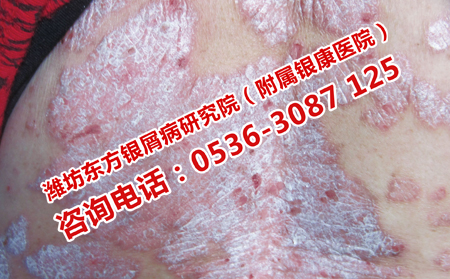 嬰兒如何避免染上牛皮癬