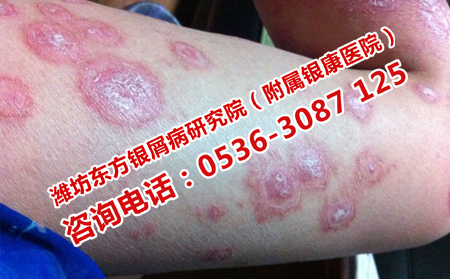 哪種方法治療牛皮癬管用