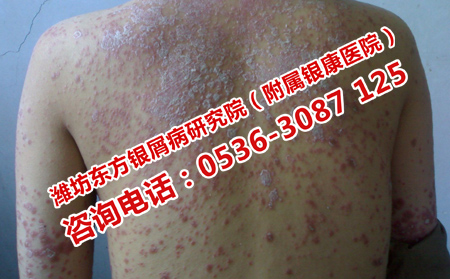 牛皮癬治療效果好的治療方法