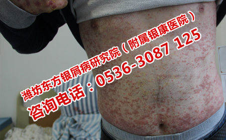 與銀屑病發生有關的因素