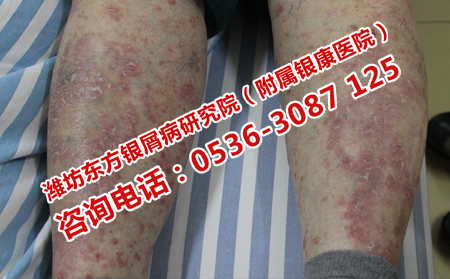 高溫天氣里牛皮癬患者如何進行日常護理呢