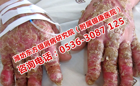 濰坊治療牛皮癬專業的醫院怎么去