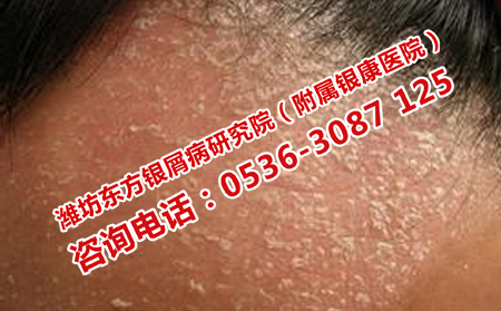 銀屑病產生的原因