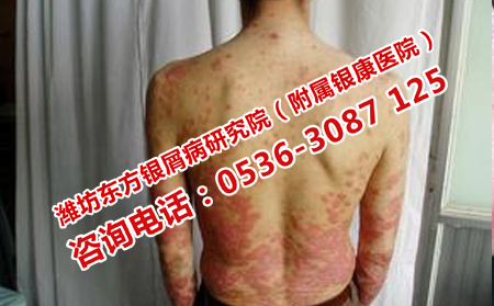 如何治療慢性銀屑病