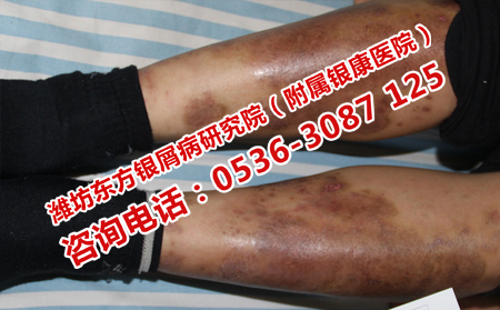 銀屑病治療恢復醫院
