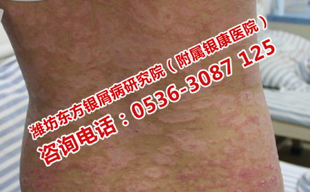 炎熱的季節(jié)銀屑病患者護(hù)理關(guān)鍵是