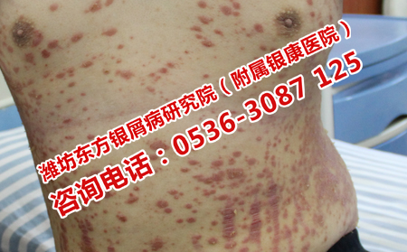 夏天哪些因素會(huì)導(dǎo)致牛皮癬的出現(xiàn)