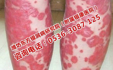 濰坊哪家醫院治療牛皮可以