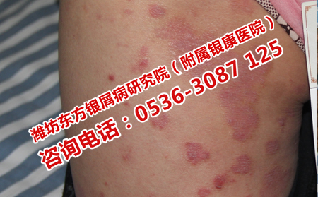 預(yù)防牛皮癬需要注意的細(xì)節(jié)問(wèn)題