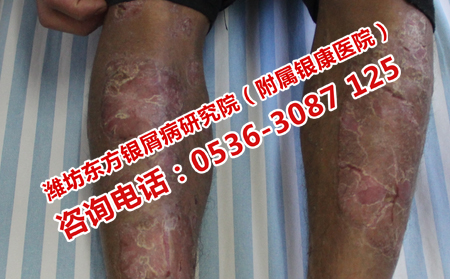 減少牛皮癬的復(fù)發(fā)的治療方法