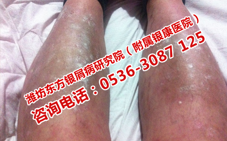 牛皮癬為什么常見