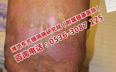 牛皮癬患者應該吃點什么