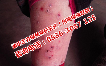 牛皮癬恢復怎么治療