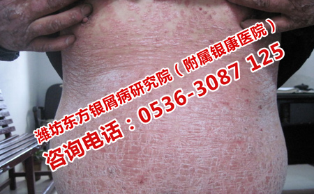 牛皮癬在身上出現(xiàn)的原因