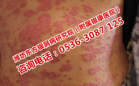 牛皮癬患者在日常有哪些禁忌