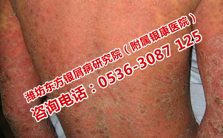 如何取得牛皮癬恢復效果