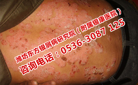 身上牛皮癬復發跟什么有關