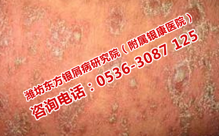 短期內的牛皮癬治療