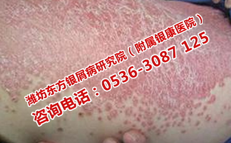 牛皮癬三方面的防護(hù)