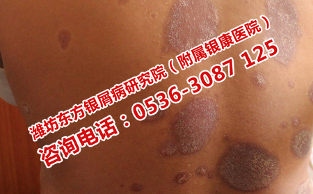 怎樣做好防止牛皮癬發生