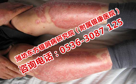 濰坊牛皮癬醫院治療方法