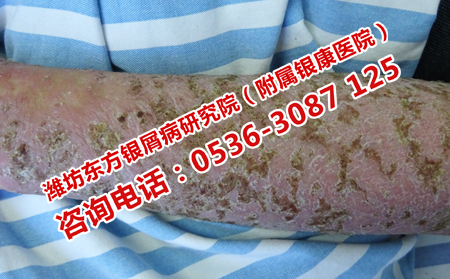 牛皮癬治多久能可以